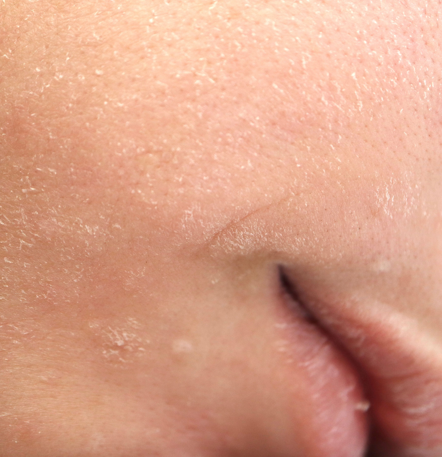 敏感肌や治療中の肌にも施術できるLDM