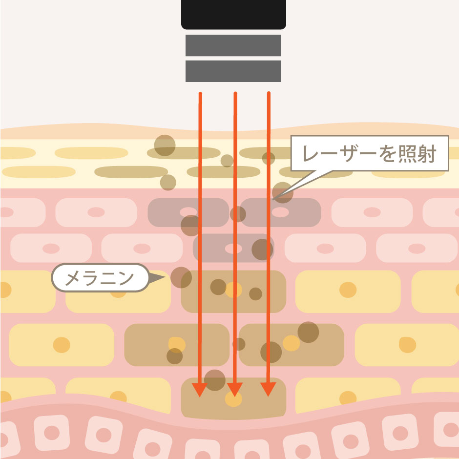 シミ・そばかすの改善